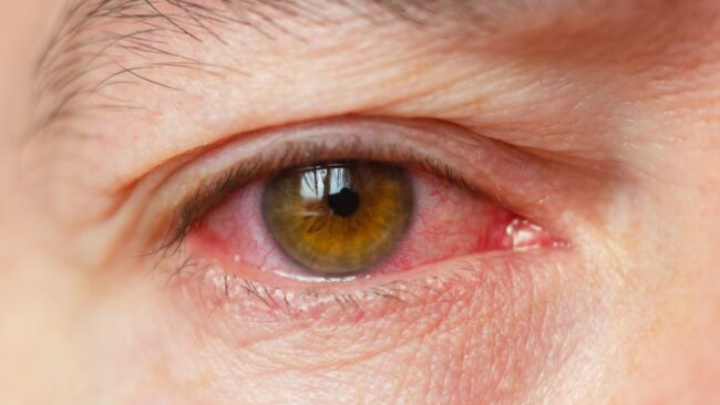 what is Eye Flu Eye Flu